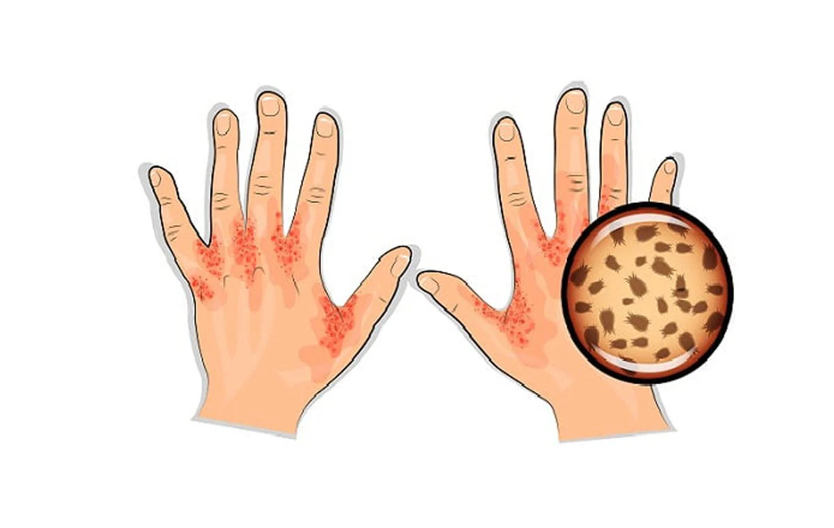 what is scabies disease