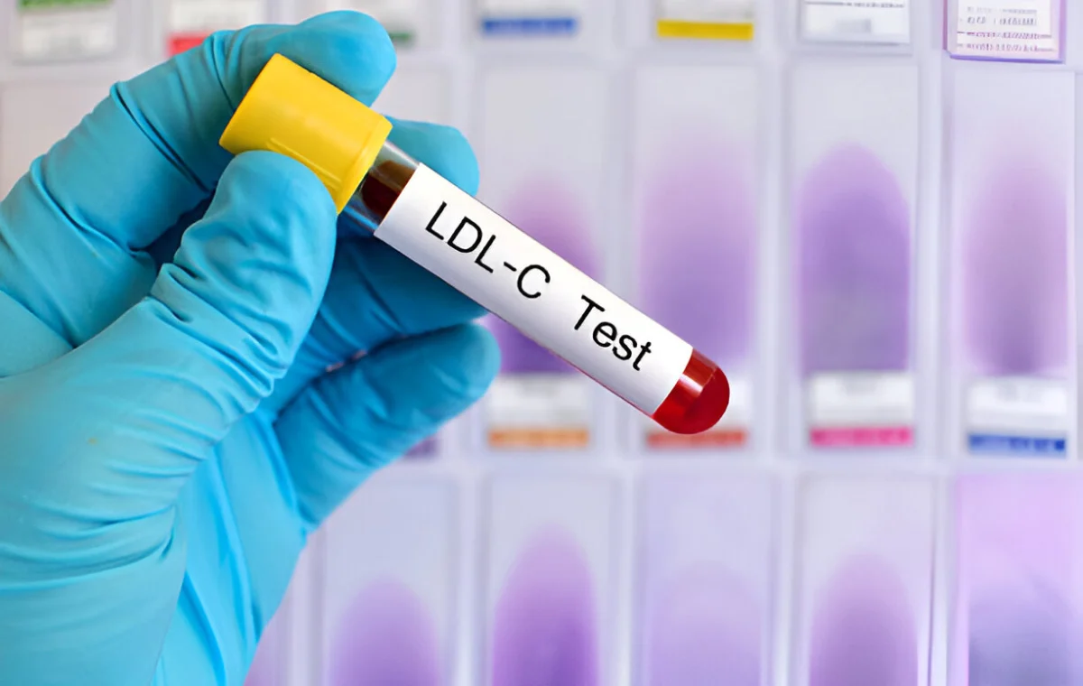 کاهش کلسترول بد با خوردن لوبیا چیتی